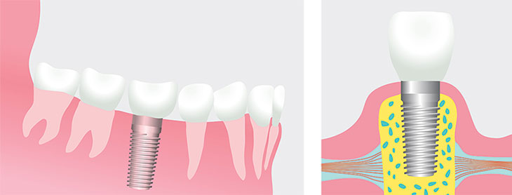 dental-implants